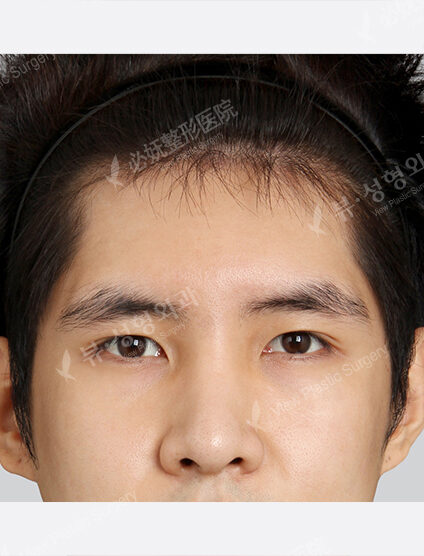 Forehead Fat Graft(2 Months) — After