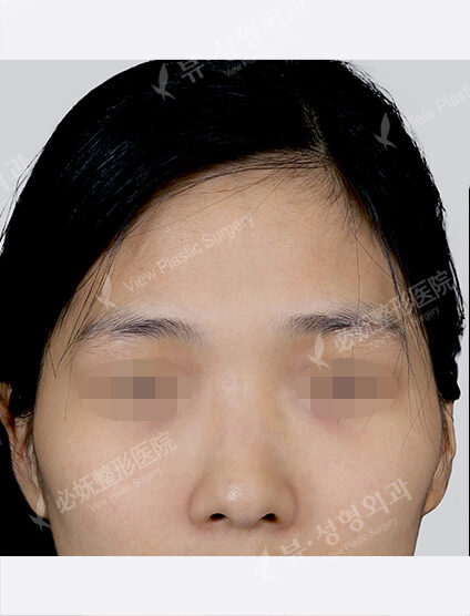 Forehead Fat Graft(2 Months) — Before