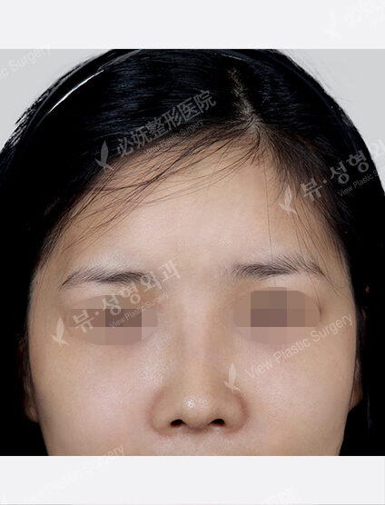 Forehead Fat Graft(2 Months) — After