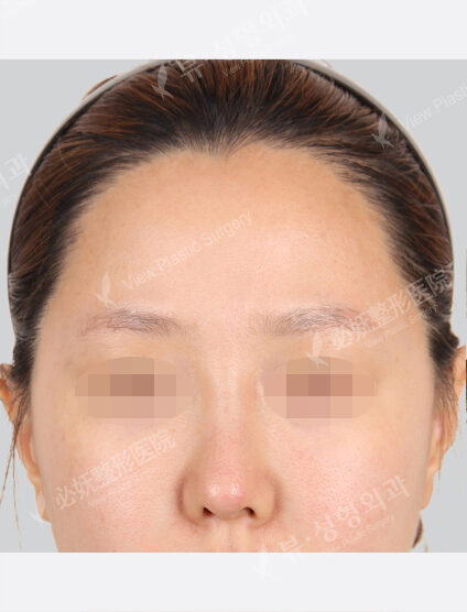 Forehead Fat Graft(2 Months) — Before
