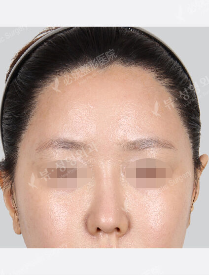 Forehead Fat Graft(2 Months) — After