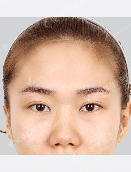 Forehead Fat Graft(2 Months) — Before