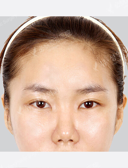 Forehead Fat Graft(2 Months) — After