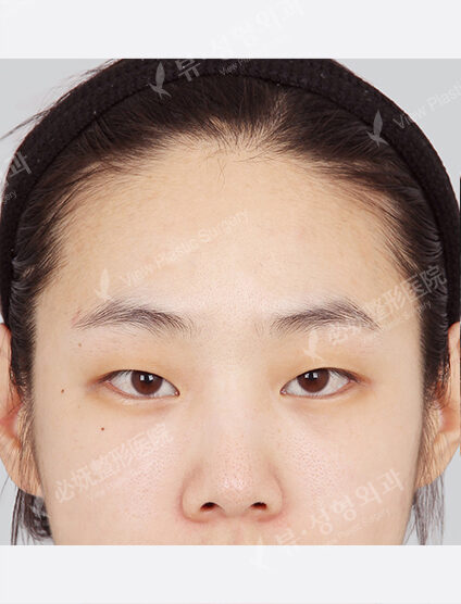Forehead Fat Graft(2 Months) — Before