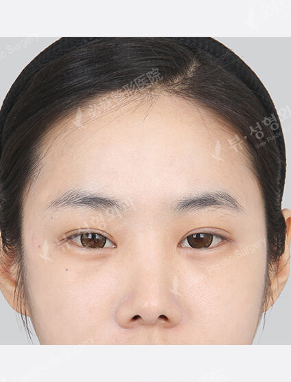 Forehead Fat Graft(2 Months) — After