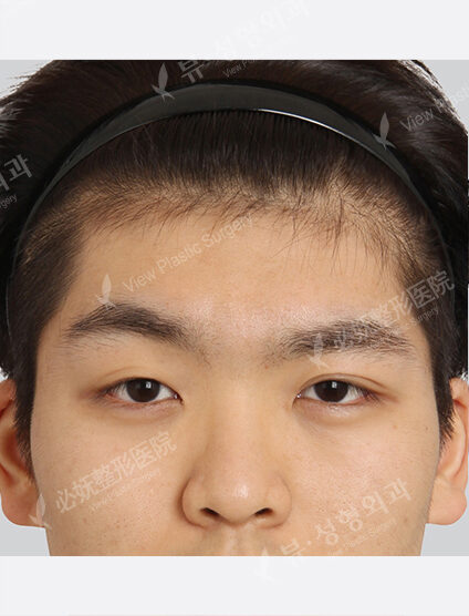 Forehead Fat Graft — Before