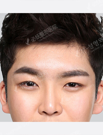 Forehead Fat Graft — After