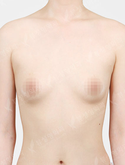 Breast Augmentation (Motiva) — Before