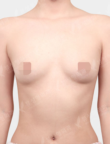 Breast Augmentation (Motiva) — Before