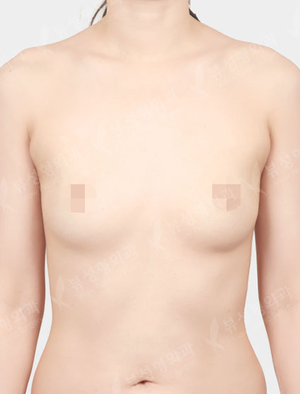 Breast Augmentation (Motiva) — Before