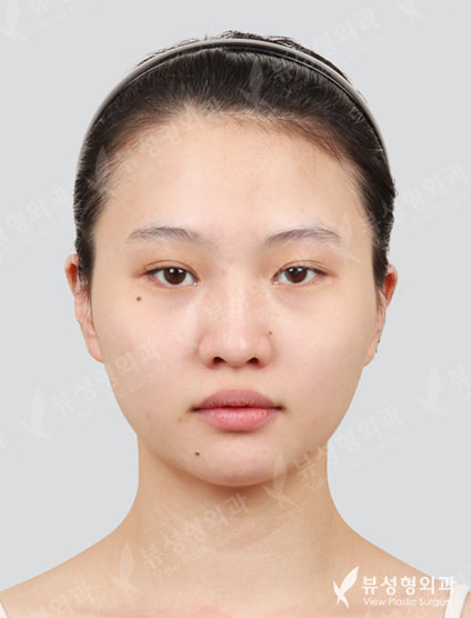 3 Types Face Contouring+Low Nose — Before