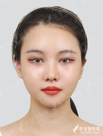 3 Types Face Contouring+Low Nose — After