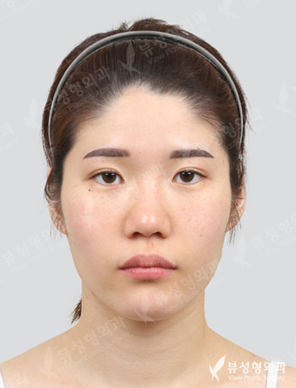 3 Types Face Contouring+Revisional Rhinoplasty+Double Eyeild — Before