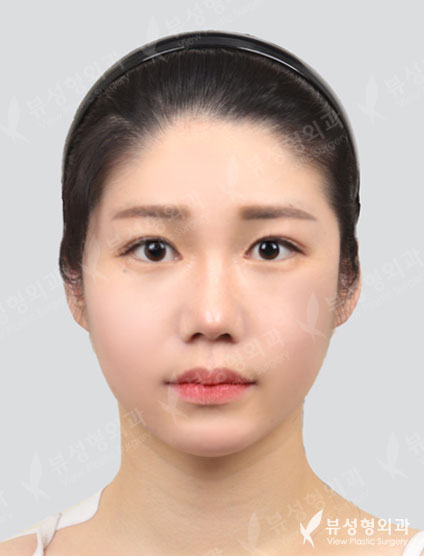 3 Types Face Contouring+Revisional Rhinoplasty+Double Eyeild — After
