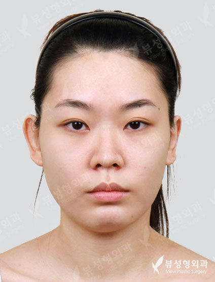 3 Types Face Contouring+Revisional Rhinoplasty+Double Eyeild — Before