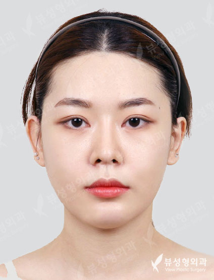 3 Types Face Contouring+Revisional Rhinoplasty+Double Eyeild — After