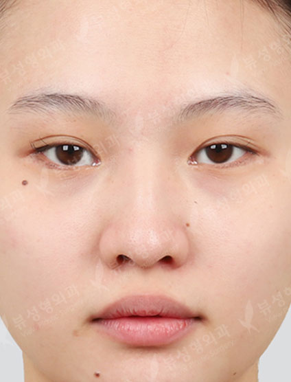 Low Nose — Before