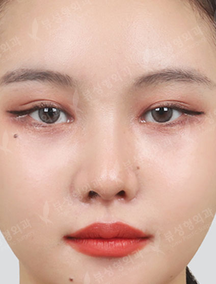 Low Nose — After