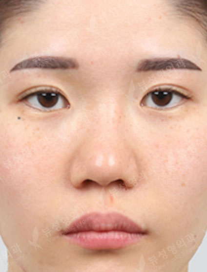 Revisional Rhinoplasty — Before