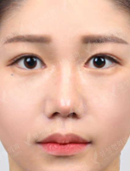 Revisional Rhinoplasty — After