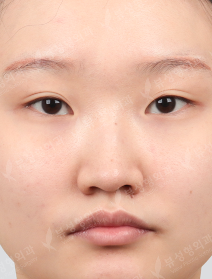 Revisional Rhinoplasty — Before