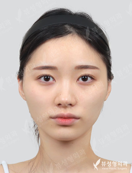 3 Types Face Contouring + Rhinoplasty — Before