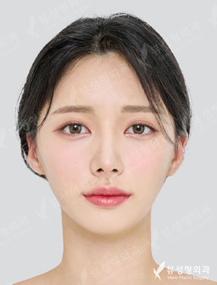 3 Types Face Contouring + Rhinoplasty — After