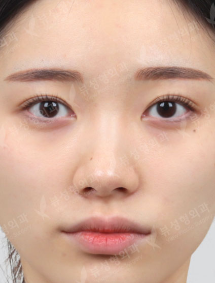 Rhinoplasty + 3 Types Face Contouring — Before