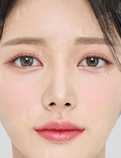 Rhinoplasty + 3 Types Face Contouring — After