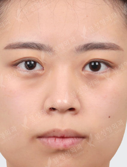 Rhinoplasty + Types Face Contouring + Fat Graft — Before