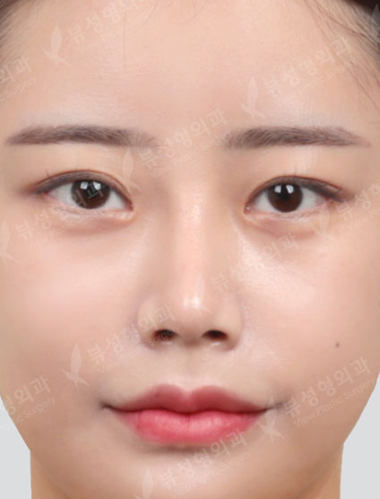 Rhinoplasty + Types Face Contouring + Fat Graft — After