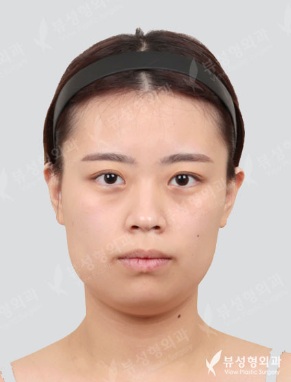 3 Types Face Contouring + Rhinoplasty + Fat Graft — Before