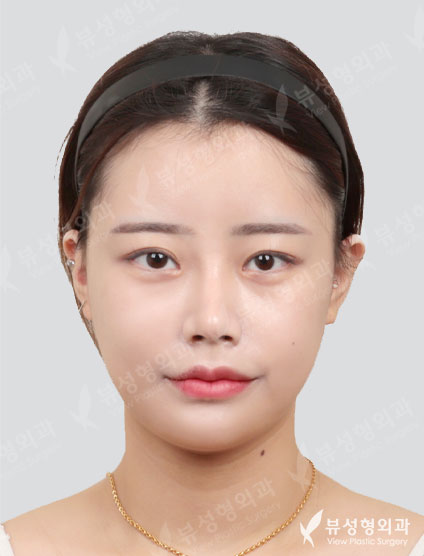 3 Types Face Contouring + Rhinoplasty + Fat Graft — After