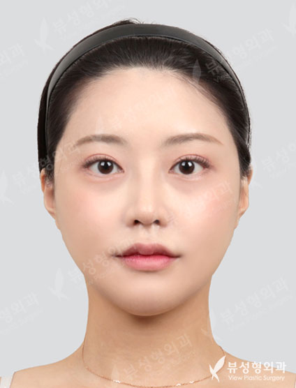 3 Types Face Contouring + Rhinoplasty — After