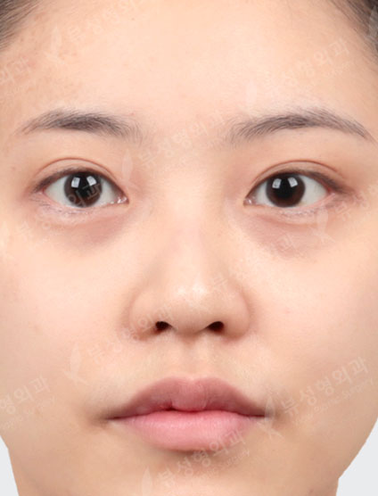 Rhinoplasty + 3 Types Face Contouring — Before