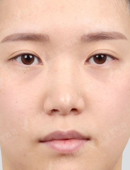 Rhinoplasty — Before