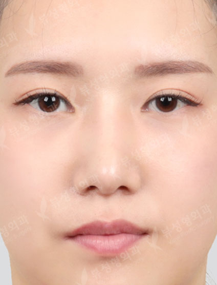 Rhinoplasty — After