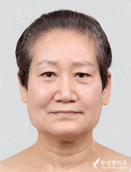 Brow lift + Lower blepharoplasty + Thread lift — Before