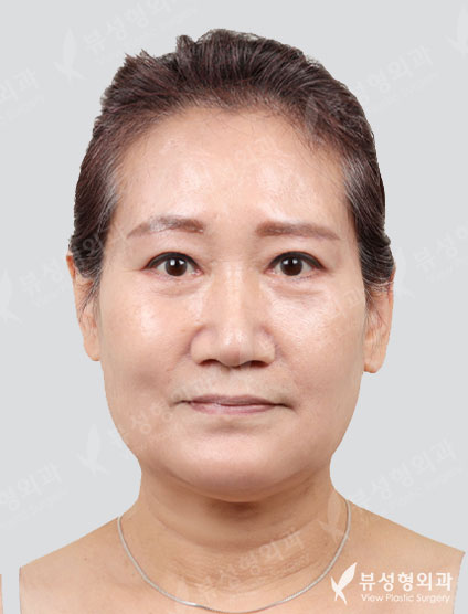 Brow lift + Lower blepharoplasty + Thread lift — After