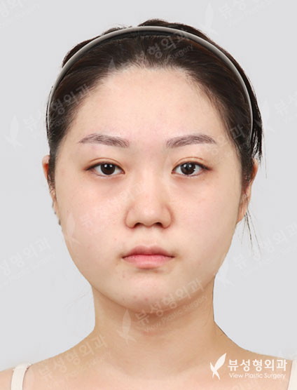 3 Types Face Contouring + Pyriform Augmentation + Fat Graft (11 Months) — Before