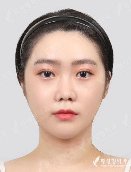 3 Types Face Contouring + Pyriform Augmentation + Fat Graft (11 Months) — After