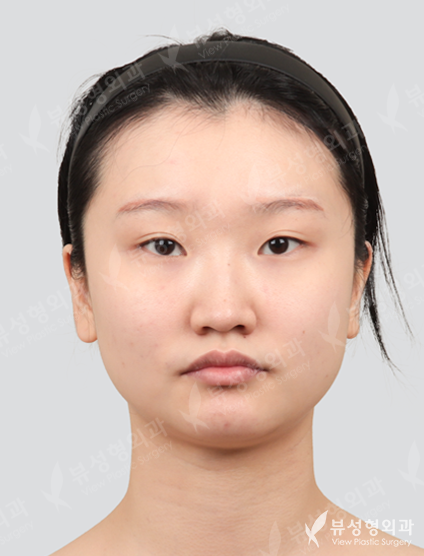 3 Types Face Contouring + Rhinoplasty + Double Eyelid Revisional Surgery (5 Months) — Before