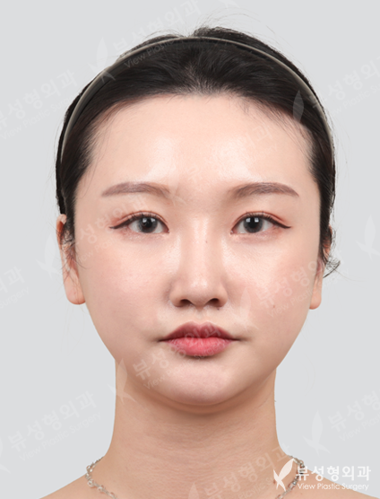 3 Types Face Contouring + Rhinoplasty + Double Eyelid Revisional Surgery (5 Months) — After