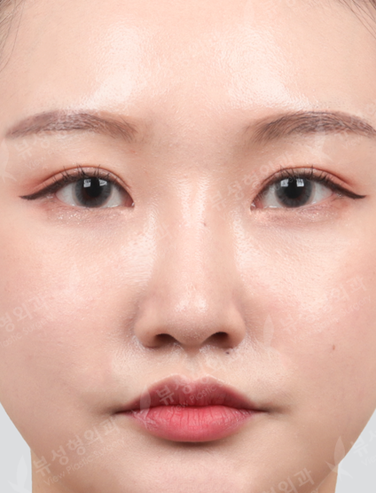 Rhinoplasty + 3 Types Face Contouring + Double Eyelid Revisional Surgery (5 Months) — After