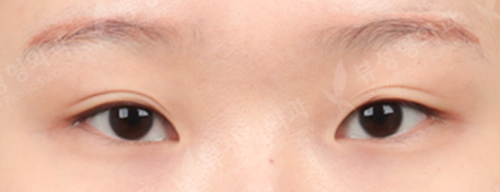 Double Eyelid Revisional Surgery + 3 Types Face Contouring + Rhinoplasty (5 Months) — Before