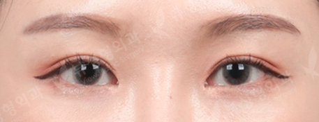 Double Eyelid Revisional Surgery + 3 Types Face Contouring + Rhinoplasty (5 Months) — After