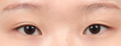 Double Eyelid Revisional Surgery (5 Months) — Before