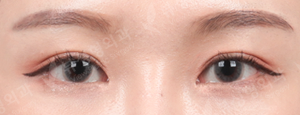 Double Eyelid Revisional Surgery (5 Months) — After