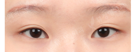 Double Eyelid Revisional Surgery (5 Months) — Before