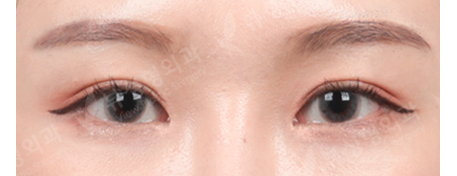 Double Eyelid Revisional Surgery (5 Months) — After